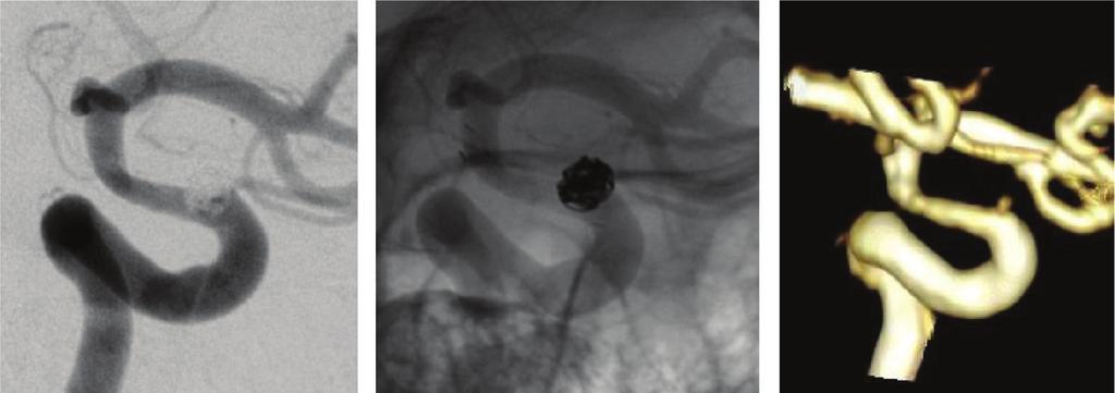 (B) Left carotid angiogram immediately after coil embolization with ES shows complete occlusion of the aneurysm (arrow). Arrowheads indicate tantalum markers at either end of the ES.