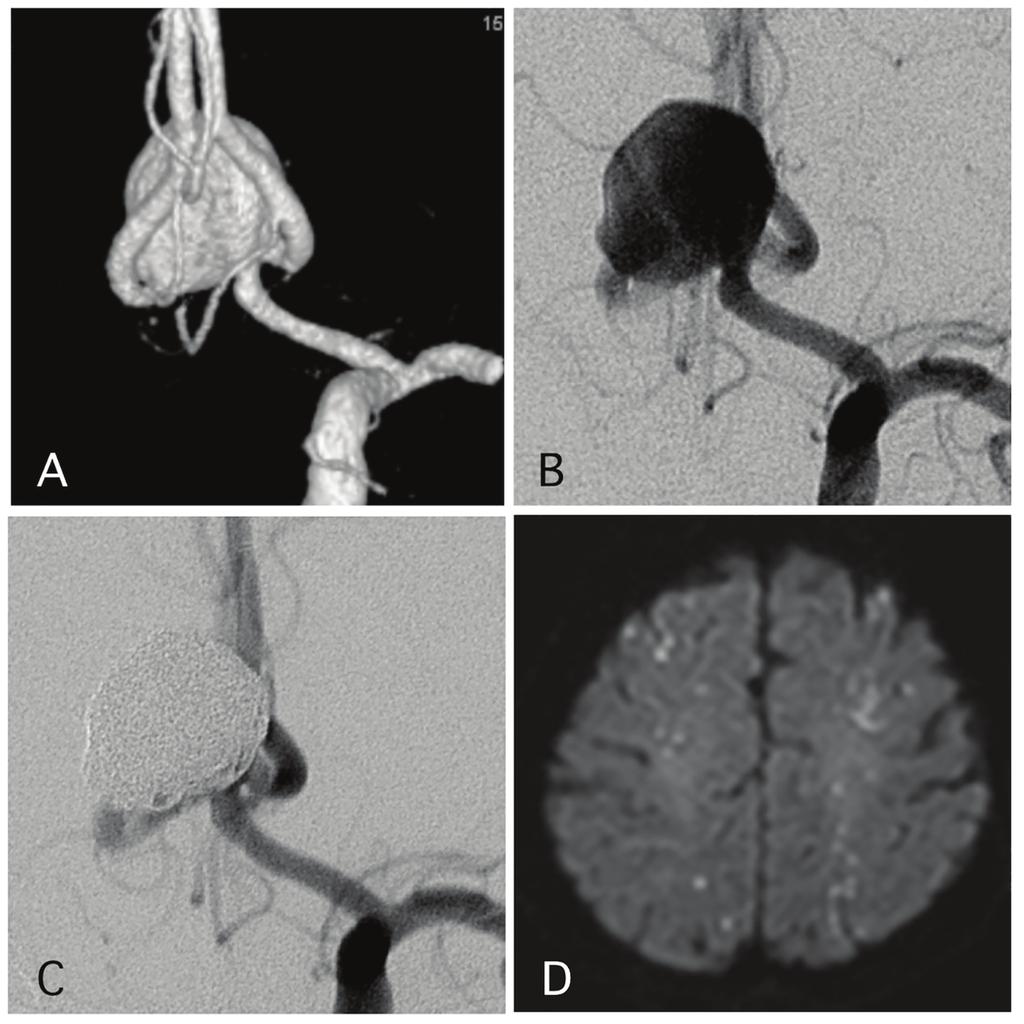 Harada et al J Neurol Res. 2016;6(4):72-80 Figure 1. A representative case of a post-procedural ischemic stroke.
