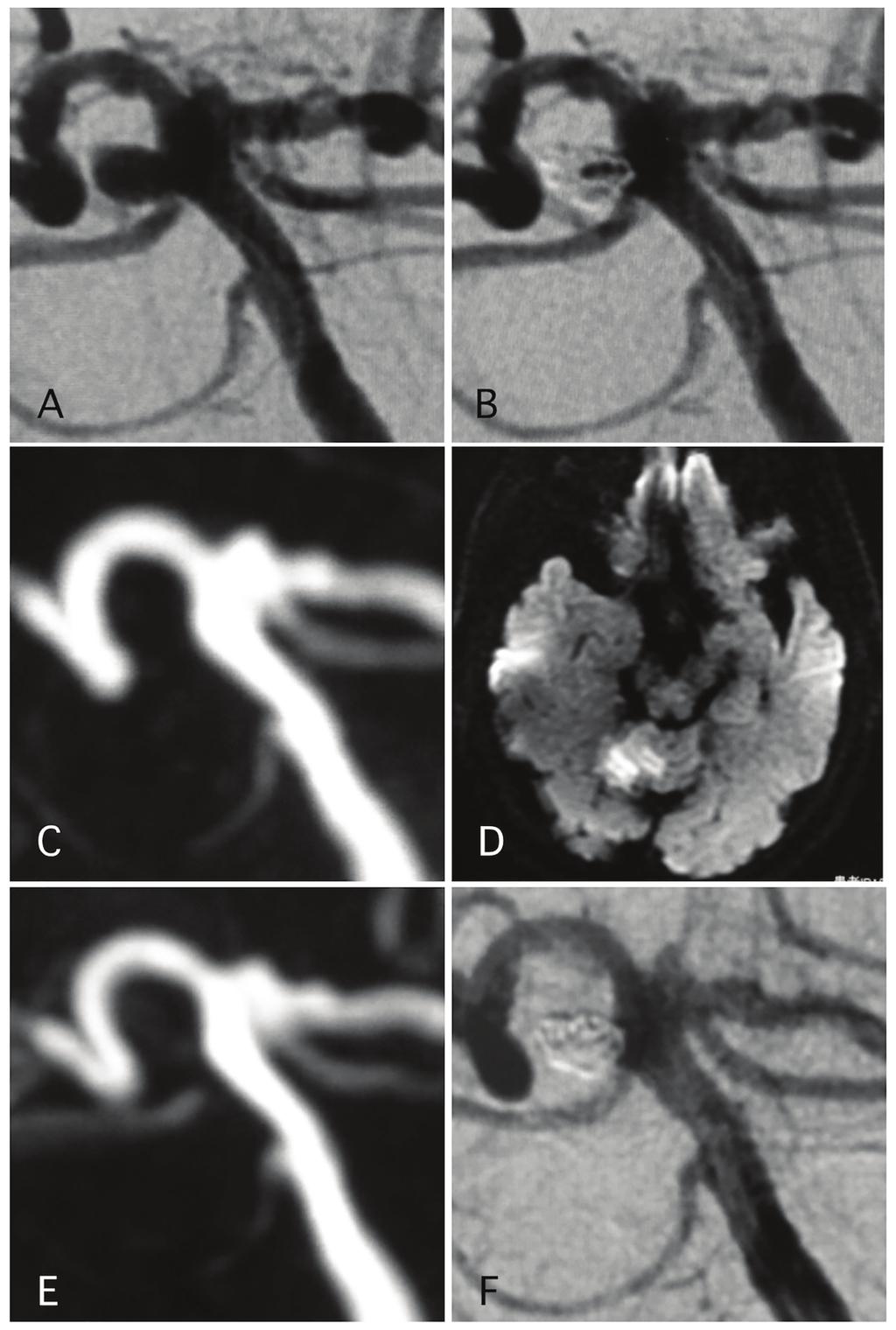 Antiplatelet Therapy of Cerebral Aneurysms J Neurol Res. 2016;6(4):72-80 Figure 2. A representative case of post-procedural ischemic stroke.