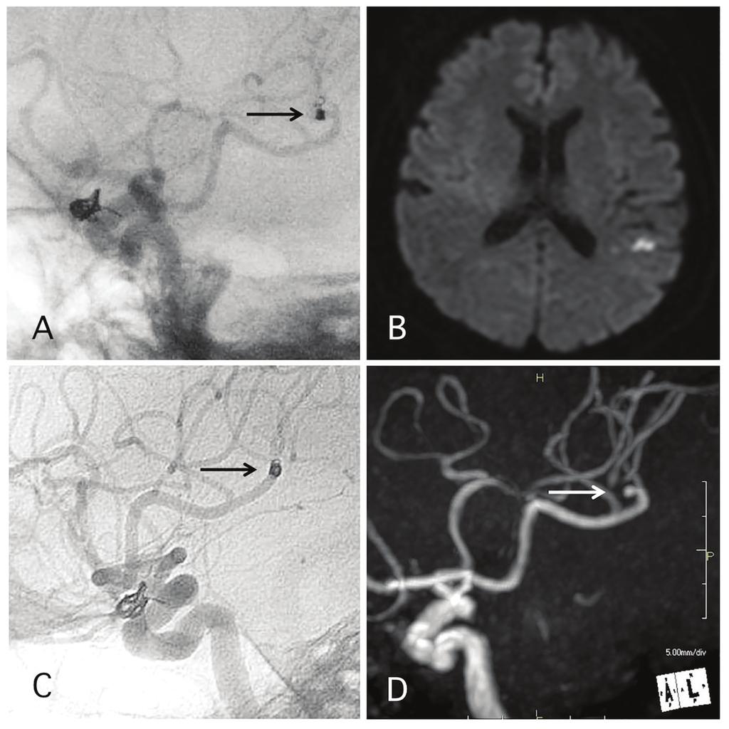 Antiplatelet Therapy of Cerebral Aneurysms J Neurol Res. 2016;6(4):72-80 Figure 4. A representative case of post-procedural coil migration.