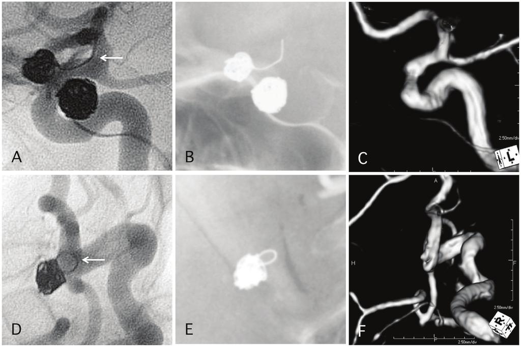Antiplatelet Therapy of Cerebral Aneurysms J Neurol Res. 2016;6(4):72-80 Figure 6. Two representative cases of post-procedural coil protrusion.