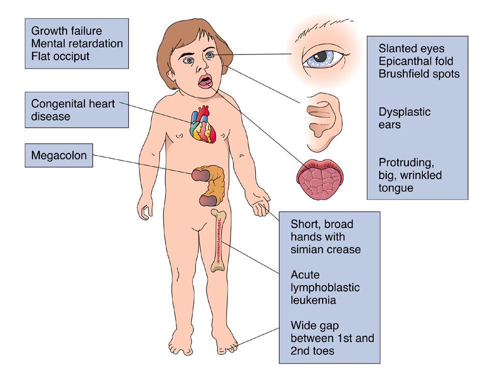 Genetic Disorders Symptoms: Small head, flattened in the back Broad, flat