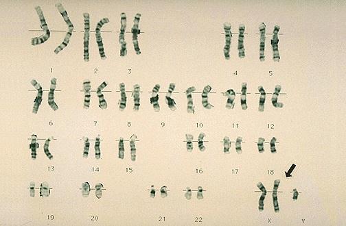Genetic Disorders Kleinfelter s Syndrome; Trisomy 23 Extra sex chromosome
