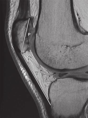 The exclusion criteria were as follows: MRI reports with clinical history of PFI or anterior knee pain or MRI findings of patellar dislocation, subluxation, or malalignment; MRI findings of patellar