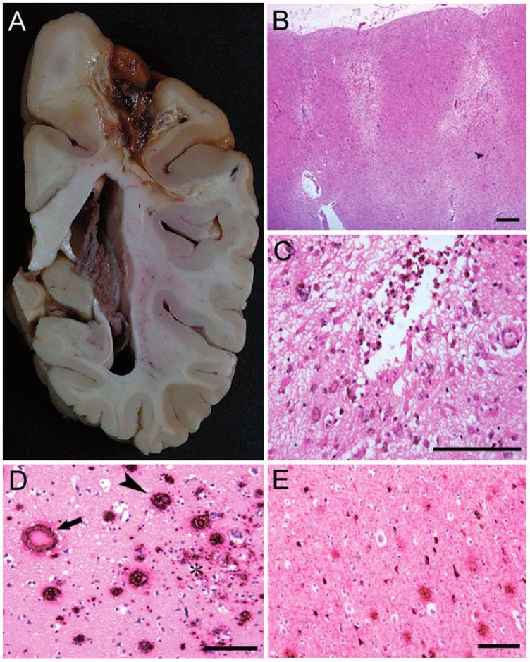 Pre-existing dementia in intracerebral haemorrhage Brain 2010: 133; 3281 3289 3287 Figure 3 Neuropathological findings in a 68-year-old female who died 7 months after onset of lobar intracerebral