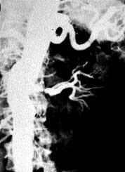 99%) stenosis on a later arteriogram (panel B).
