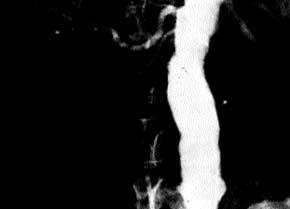 ipsilateral kidney size correlate significantly with progressive occlusive disease.