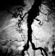 ) FIGURE 3-32 Pathologic specimen of kidney beyond a main renal artery occlusion in a patient with severe bilateral renal artery stenosis and a serum creatinine of 4.5 mg/dl.