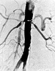 renovascular hypertension in which significant arterial stenosis is present and sufficient to produce renal tissue ischemia and initiate a pathophysiologic sequence of events leading to elevated
