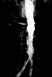 Repeat aortogram 3 years later demonstrated patency of the left renal artery.