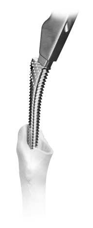A traditional rasping technique can be used to remove bone in the same manner as in primary surgery.