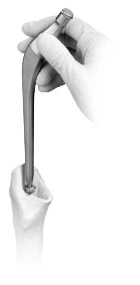 Inserting Provisional Stems Select the provisional stem based on rasp size or preoperative planning.