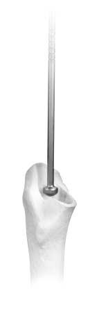 If the IM Sizer is tight in the canal, choose a Provisional Distal Centralizer one size smaller than the size of the IM Sizer.