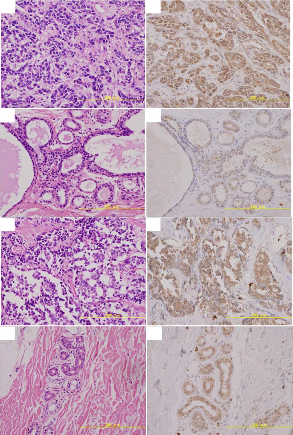 Yamashita et al. BMC Cancer (2017) 17:589 Page 14 of 21 a b c d e f g h Fig. 2 Immunostaining and HE staining of choline kinase in breast cancer and corresponding normal breast tissues.