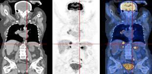 Well Positioned to Grow in Emerging Market Segments Fusion of of morphological and and molecular imaging Example of PET-CT fusion technology Morphological imaging: High spatial resolution allows for