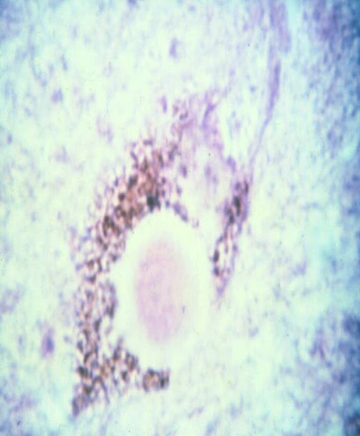 PATHOLOGY OF PARKINSON S DISEASE CHARACTERIZED BY