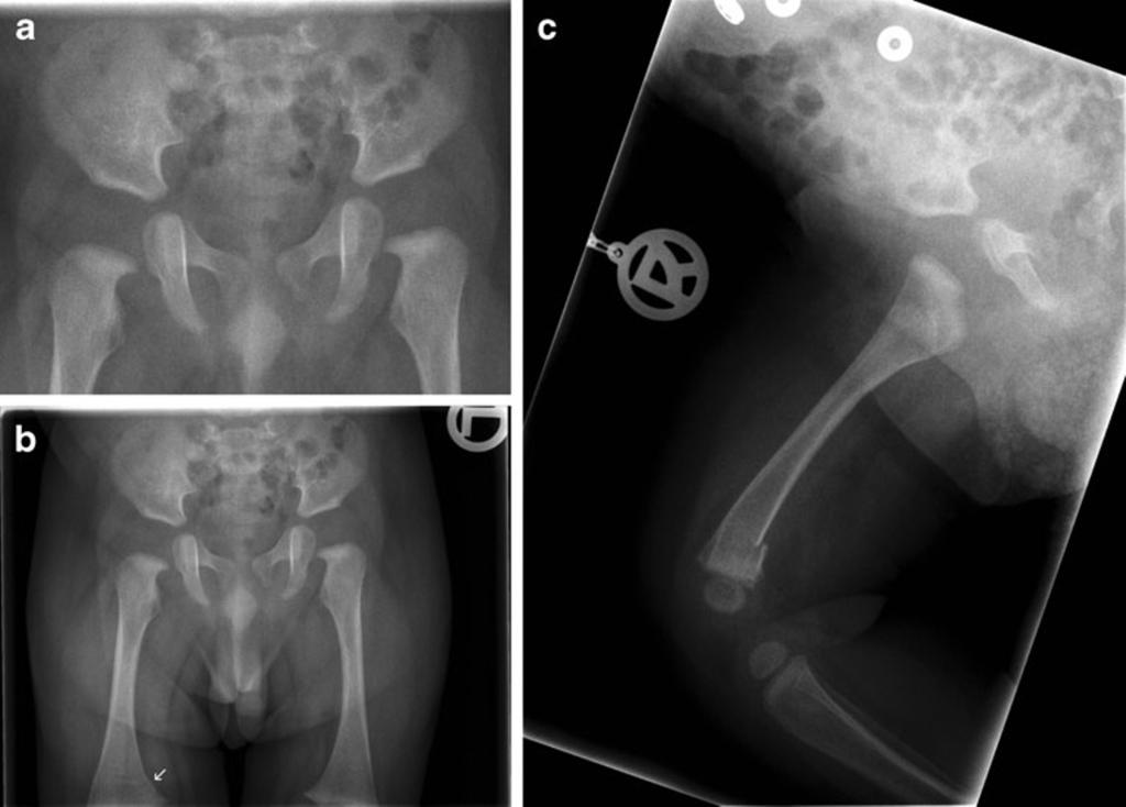 Insights Imaging (2013) 4:723 727 725 Fig. 2 a c A 6-month-old boy with restricted movement of the right hip. a Electronically collimated AP view of the pelvis, normal hips.
