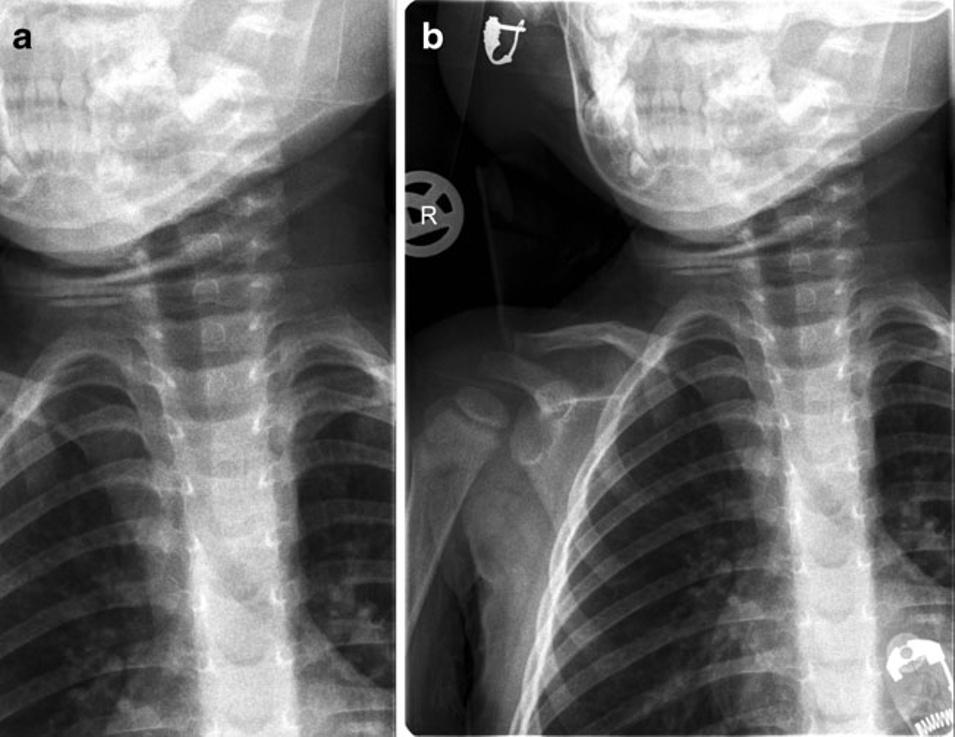 c Lateral view confirming fracture Case 2 A 3-year-old girl was referred for an X-ray of the cervical spine, because of mild torticollis after a fall. On the electronically collimated images (Fig.