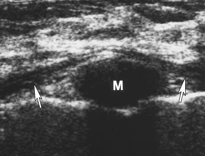 Cartilaginous rib mimics solid breast mass on sonography of normal breast in 46-year-old woman.