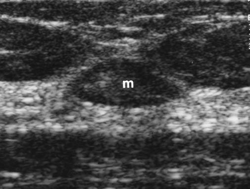 Sonographic imaging of submamillary tissue should be performed from an angled or coronal projection because of the intense posterior acoustic shadow produced by the whirled smooth muscle bundles of