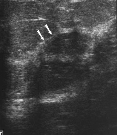 bnormality is denoted at sonography by intense acoustic attenuation without evident mass. Diagnosis was confirmed at surgery. Fig. 6.