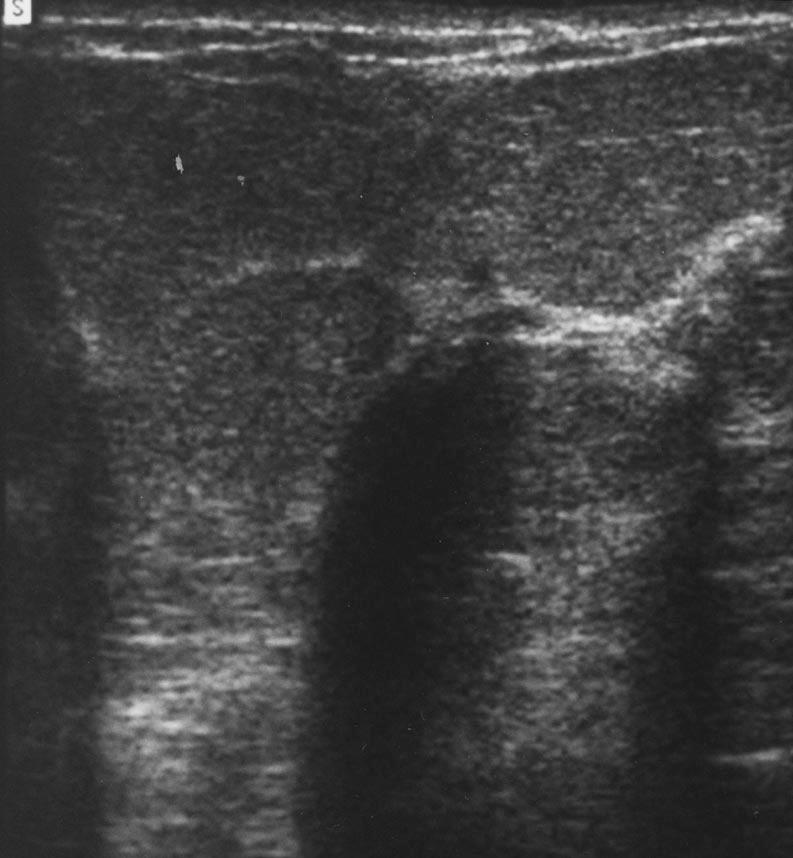 , reast sonogram reveals focus of intense acoustic attenuation without mass lesion. coustic shadowing originates from Cooper s ligament between normal fat lobules.
