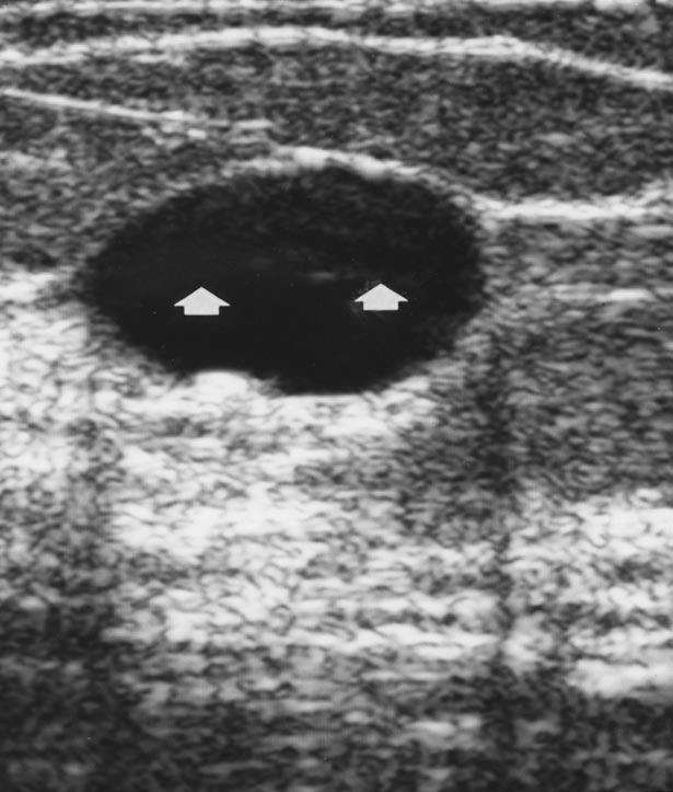 ill-defined, and an anechoic simple cyst to appear to have internal echoes due to increased partial volume effects (Fig. 12).