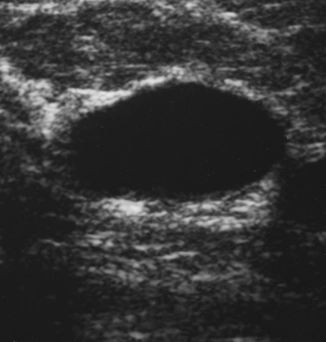 Sonographic Imaging of the reast Downloaded from www.ajronline.org by 80.243.135.192 on 02/26/18 from IP address 80.243.135.192. Copyright RRS. For personal use only; all rights reserved Fig. 10.