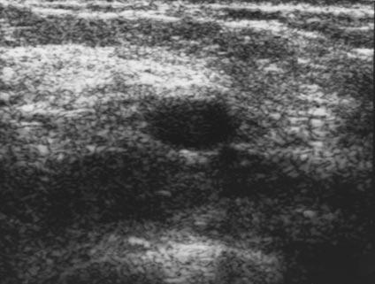 throughtransmission. Surrounding normal tissue varies from light to dark gray. Fig. 11. Fibroadenoma mimics simple cyst as result of inappropriate setting of dynamic range in 41-yearold woman.