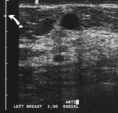 , Sonogram obtained with focal zone inappropriately placed at bottom of field of view (arrow) reveals small ill-defined hypoechoic mass with normal through-transmission suggestive of small complex