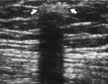 , Mediolateral oblique mammogram confirms that sonographic and palpable abnormality correspond to retained Dacron retention cuff overlying pectoralis muscle (arrow). echogenic line.