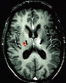 this case. Note the corresponding activation (red pixels) of the medial wall of the third ventricle, adjacent to the PVG electrode, as well as the left insula.