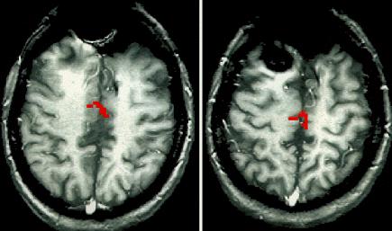 Fig. 4. Functional MR images demonstrating activation of the cingulate cortex.