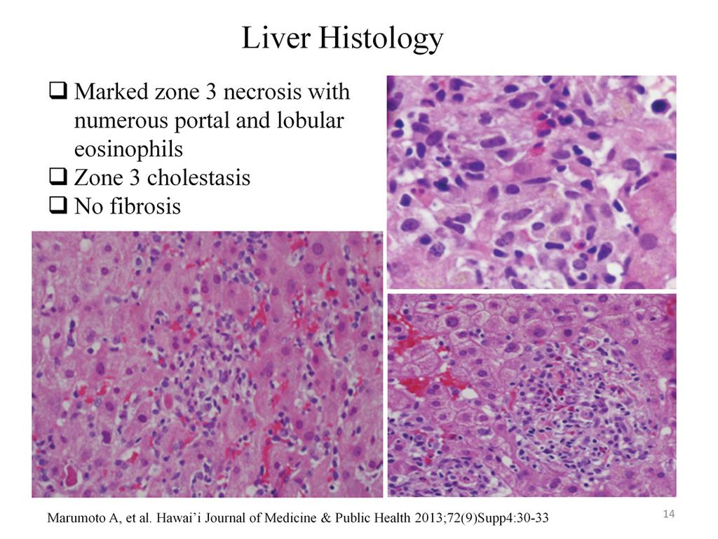 And the liver biopsies were actually published as well. And you could see very clear zone 3 necrosis with numerous portal and lobular eosinophils.