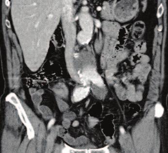 CASE 1 Infrarenal AAA and bilateral common iliac aneurysms (N.