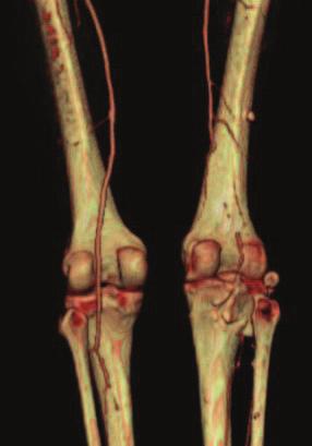 CASE 7 Popliteal artery CTO (M. Piokorwsky) Male, 61 years old Comorbidities: past smoker, COPD Current medication: aspirin, statin and salmeterol Diagnosis: PAD (Rutherford grade 5) ABI: R0.