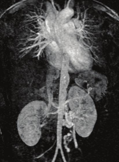 CASE 12 Obstructive post thrombotic syndrome (M. Lugli) Female, 42 years old History of DVT in 2009, with occlusion of the vena cava and the two iliac veins.