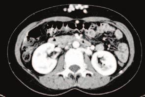 CT and MRI: No identification of the inferior vena cava on its infrarenal path, nor the iliac veins.