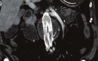 ) in March 2016 (2nd step) Diagnose: Descendent thoracic aortic aneurysm (74mm) Procedure: TEVAR Gore + CHIMPS Procedure Steps: Upper