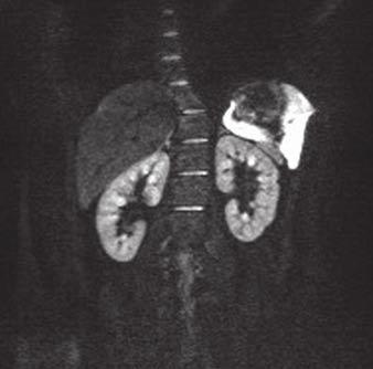 MRI of Renal Function factor were identical in the PACE and breath-hold DWI sequences.