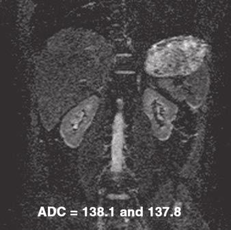 The ROC curve analysis also showed that the ADC values obtained via PACE DWI were significant predictors of a reduction in split renal function, whereas those obtained via breath-hold DWI were not.
