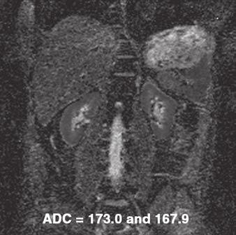 corresponding ADC maps (G and H) of subjects with normal (A, C, E, and G) and reduced (B, D, F, and H) split renal function.