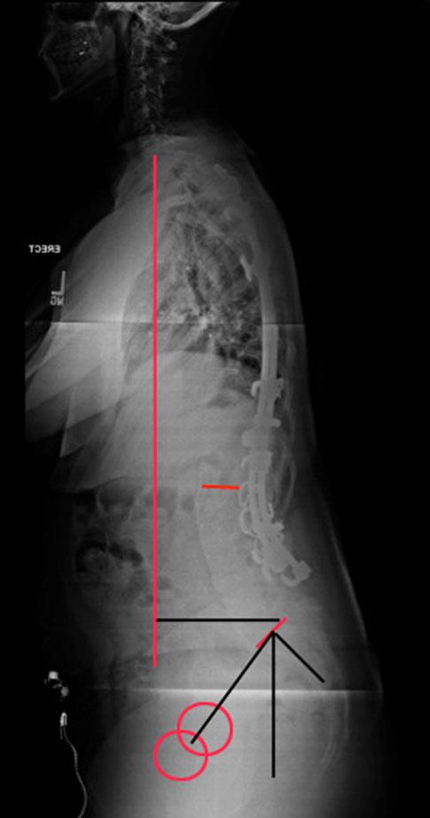 Today, it is well recognized that instrumentation with the Harrington rod into the lower lumbar spine leads to a significant loss of lumbar lordosis, further leading to a specific description known
