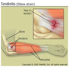 Carpal tunnel Compression to the median nerve Tendonitis Tendon inflammation Wrist, elbow,