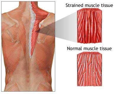 Strains Strains affect the muscle and/or tendon that attaches to the bone Injuries are typically