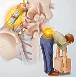 the most common forms of back injury Sprains Sprains involve a stretching of the ligament or