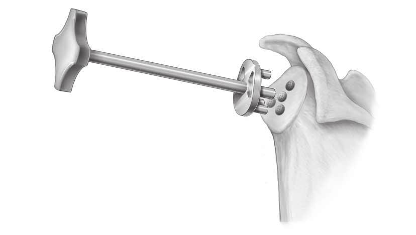 Figure 18 Drill the Center Hole Figure 19 Drill the Pegged Glenoid Figure 20 Depth Gauge for Cage Glenoid to Confirm Hole Depth Figure 21 Insert the Trial Glenoid After reaming, connect the Modular