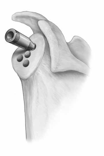 Strike the Glenoid Impactor with a mallet to ensure that the glenoid component is in complete contact with the bone.