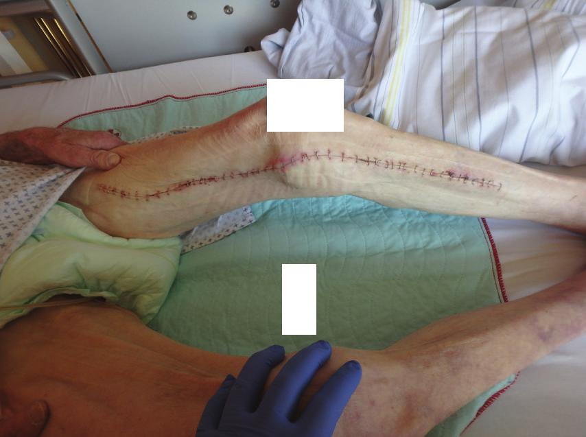4 Case Reports in Orthopedics Figure 6: Left leg after operation with good healing process. Figure 7: Operation site after operation with laparotomy scar and artificial anus (anus praeter).
