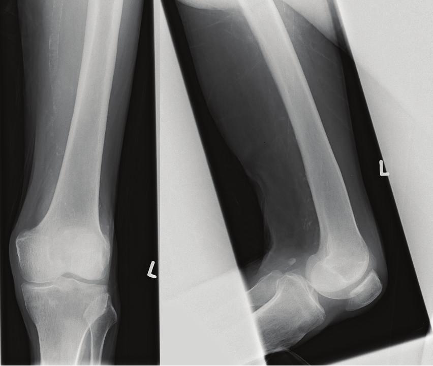Case Reports in Orthopedics 5 (a) (b) Figure8:Xraysoftheleftproximallowerlegaswellofthepelvis4monthsafteradmission. Competing Interests The authors declare that they have no competing interests.